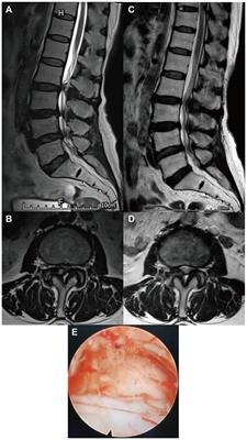 Percutaneous uniportal full-endoscopic surgery for treating symptomatic lumbar facet joint cysts under local anesthesia combined with monitored anesthesia care: a preliminary report of eight cases with at least 1 year follow-up